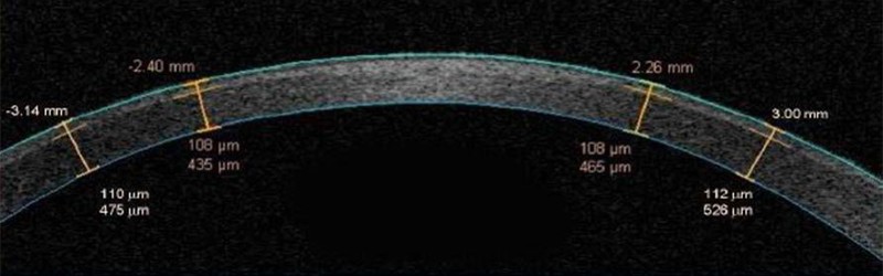 Фемтосекундный лазер iFS