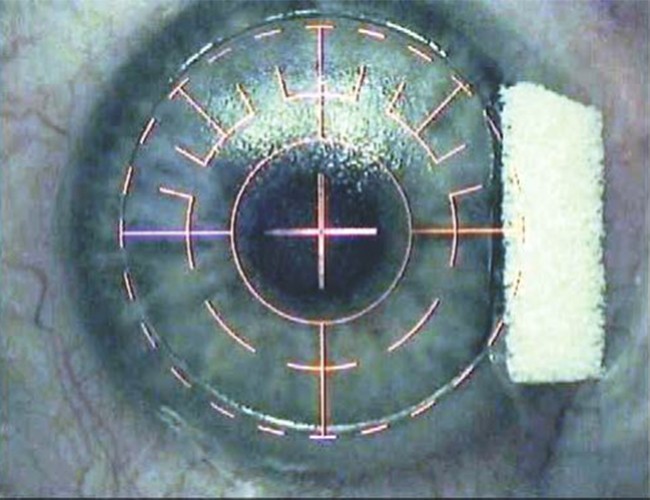 Фемтосекундный лазер iFS